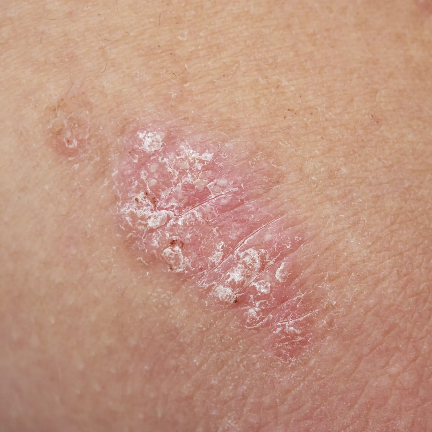 6. psoriasis