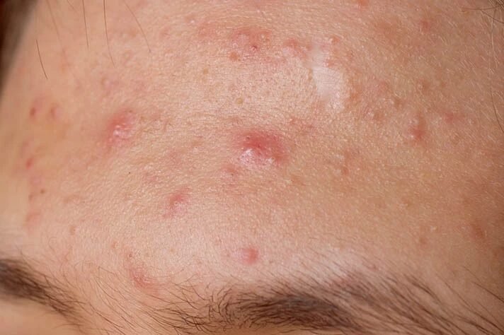 acne 1 result