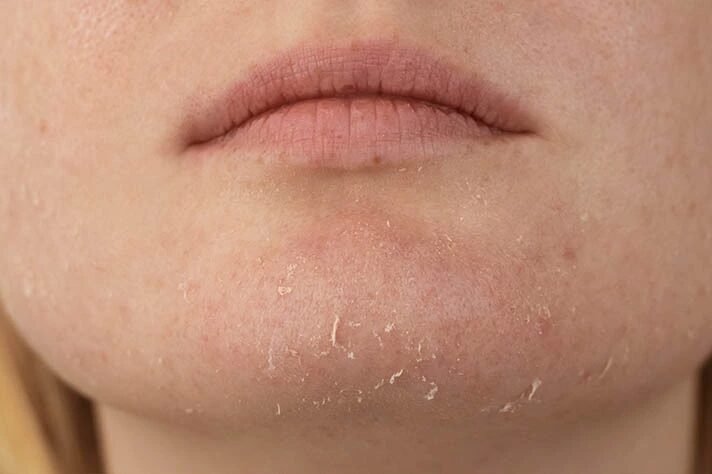 dehydrert hud 1 result