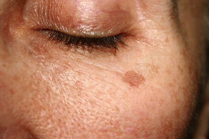 hyperpigmentering 1 result