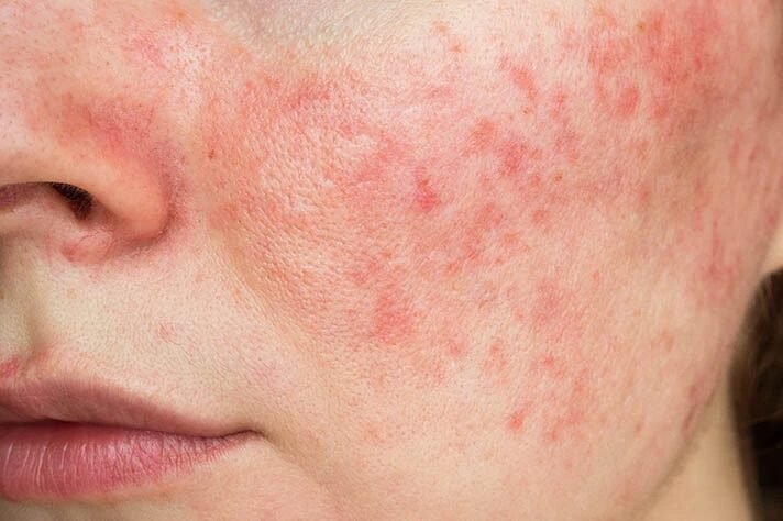 rosacea 1 result