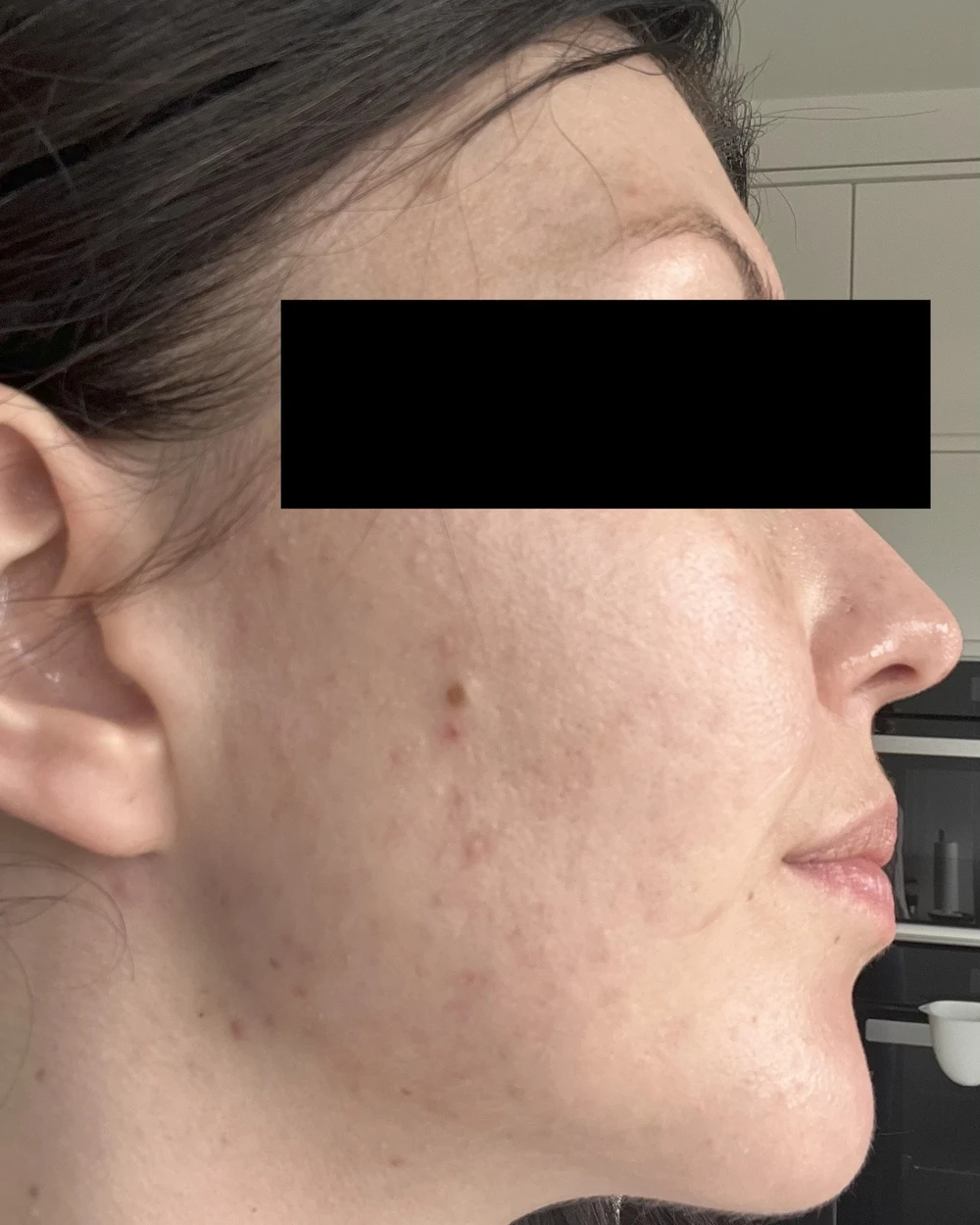 akne pie etter dermavidulas norway