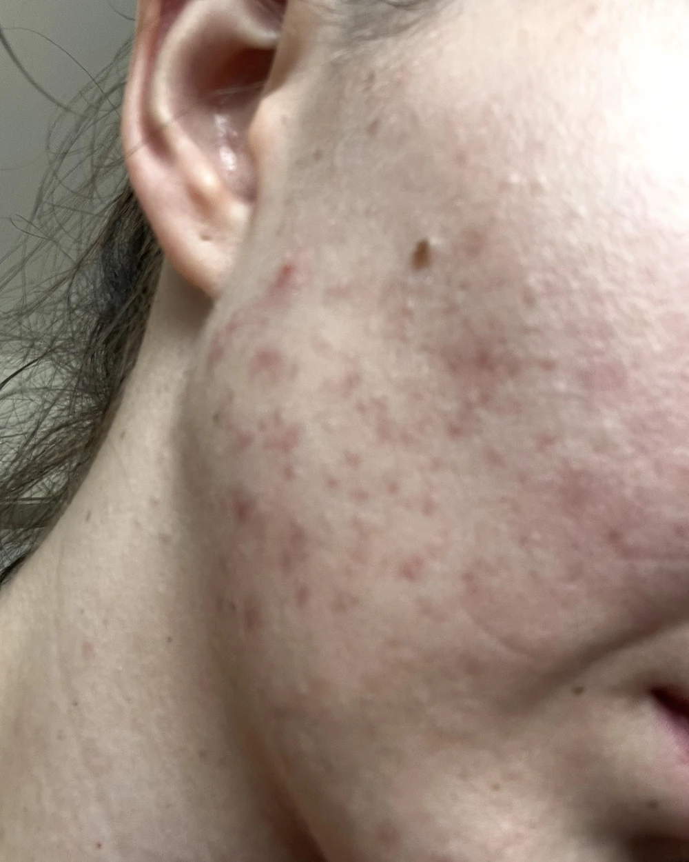 akne pie før dermavidulas norway